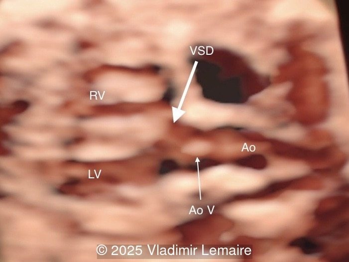 3D spatiotemporal image correlation (STIC) ultrasound volume at the level of the five-chamber view.