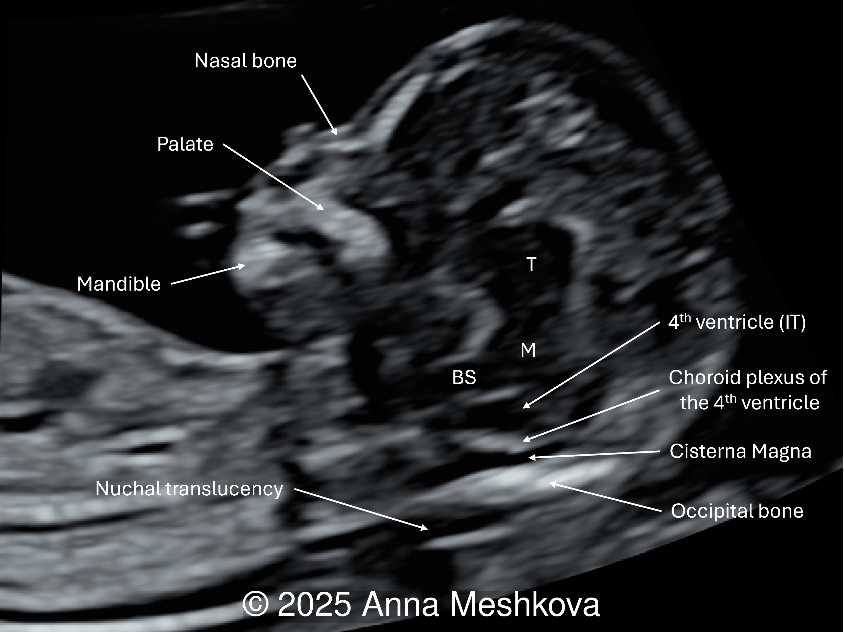 Normal fetus with intracranial translucency (IT) appearing as a fluid-filled space between the brainstem (BS) anteriorly and the choroid plexus of the 4th ventricle posteriorly. The future cisterna magna is present. (T: thalamus; M: midbrain)