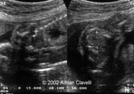 normal pulmonar part