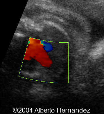 normal right outflow tract