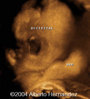 occipital defect