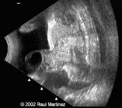 OMPHALOCELE 2