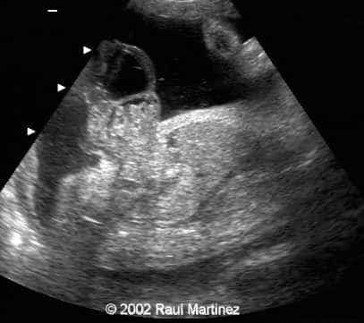 OMPHALOCELE