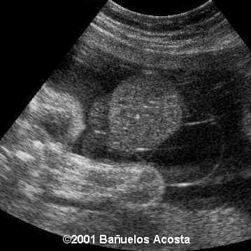 onfalocele.00