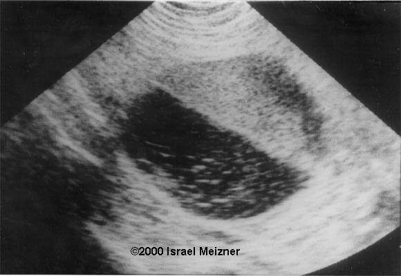 ovarian_cyst_meizner-1