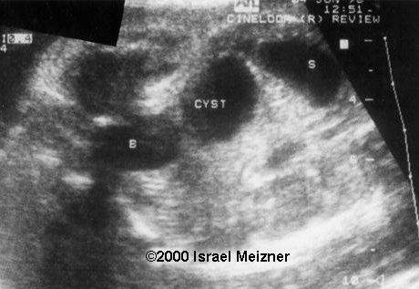 ovarian_cyst_meizner-2