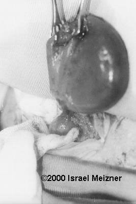 ovarian_cyst_meizner-3