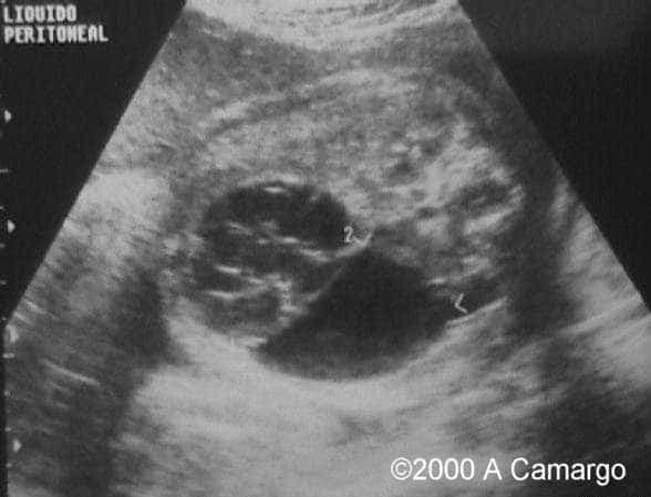 photo3_ascitis