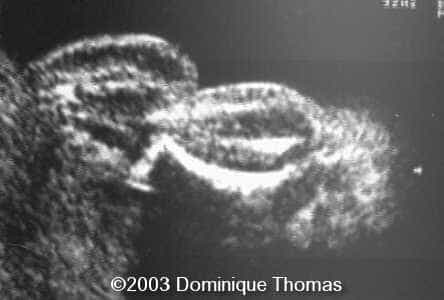 pied hypochondrogenesis