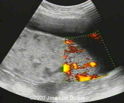placenta percreta pa