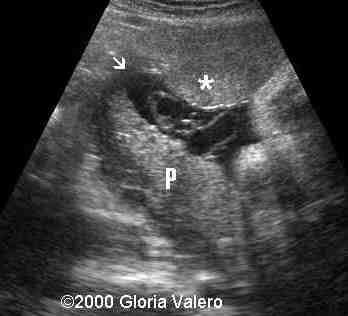 placenta_succenturiata_8_1