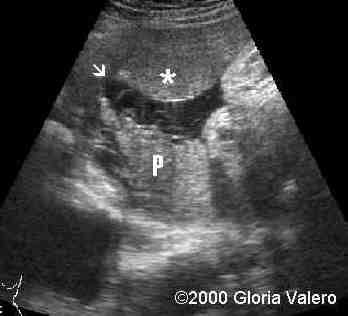 placenta_succenturiata_8_2
