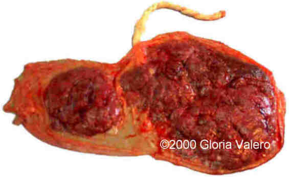 placenta_succenturiata_8_3