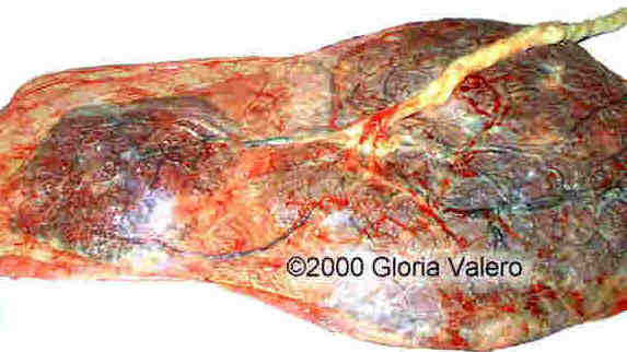 placenta_succenturiata_8_4