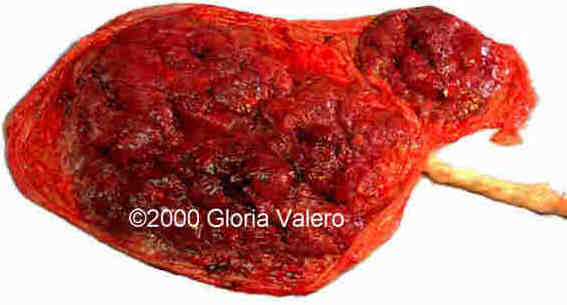 placenta_succenturiata_8_5
