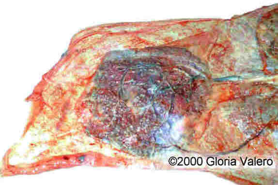placenta_succenturiata_8_6