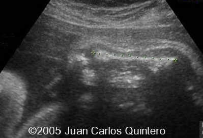 R HUMERUS