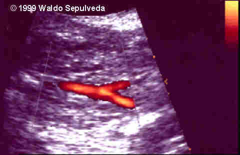 renal agenesis