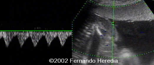 reversed perfusion1