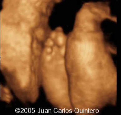 RIGHT FOOT BETWEN PLACENTA AND UTERUS