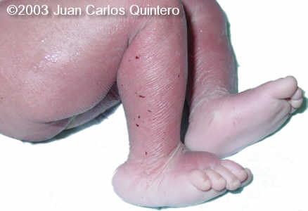 rockerbottom feet monosom 15q