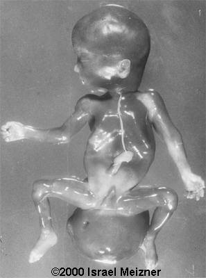 sacrococcygeal_teratoma_meizner-2