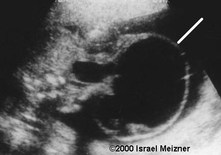sacrococcygeal_teratoma_meizner