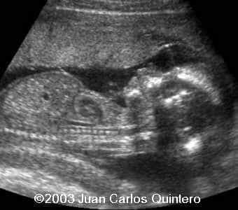 sagital 18 weeks