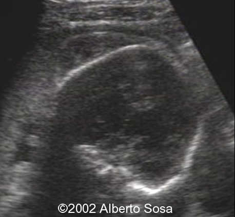 scalp tumor 1