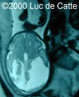 schizenc1