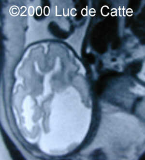 schizenc2