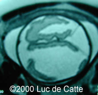 schizenc4
