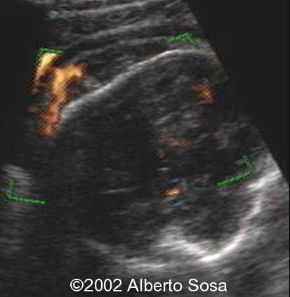 sclap tumor 2
