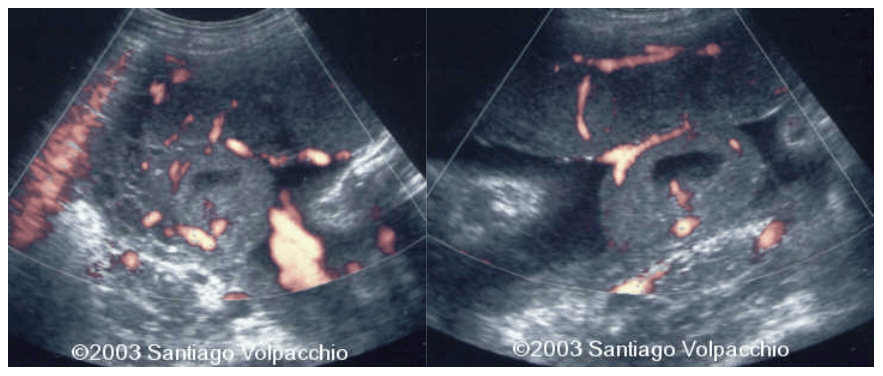 suc placenta 3