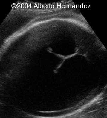 severe hydrocephalus