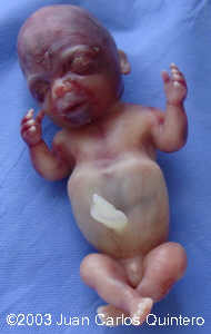 skeletal dysplasia 18 weeks