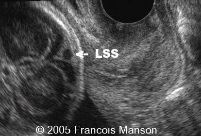 sls1