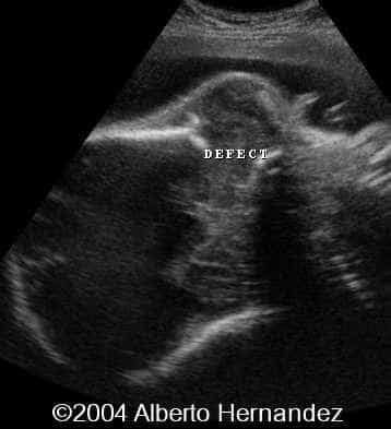 sphenoid defect