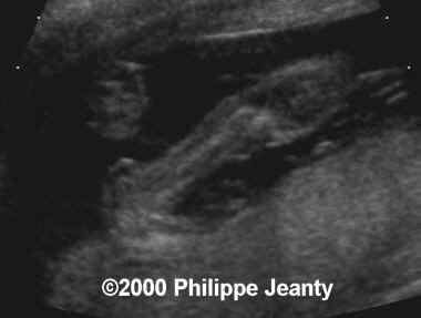 spina_bifida_clubfoot1