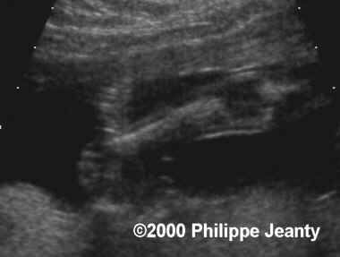 spina_bifida_clubfoot2