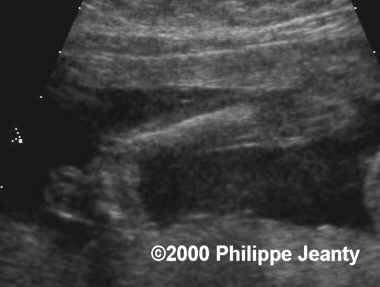 spina_bifida_clubfoot3