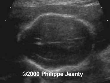 spina_bifida_lemon_head