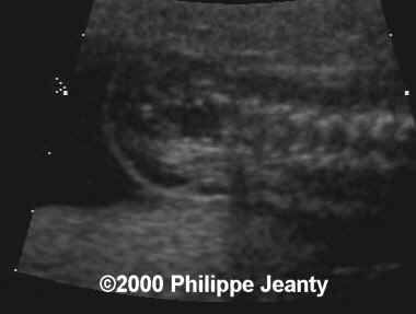 spina_bifida_mmc_1