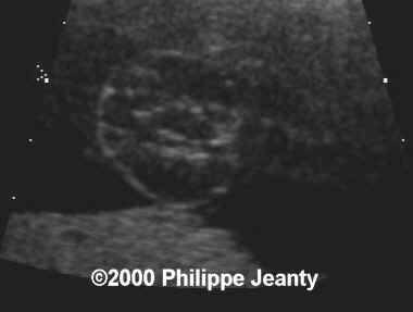 spina_bifida_mmc_2