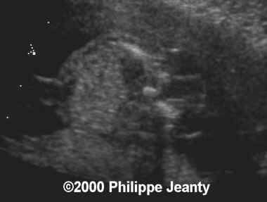 spina_bifida_mmc_3