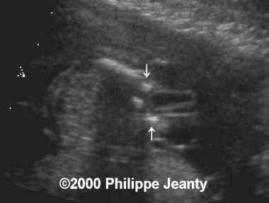 spina_bifida_mmc_5
