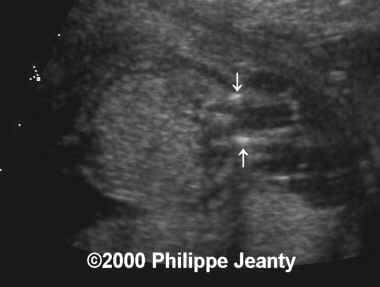 spina_bifida_sb3