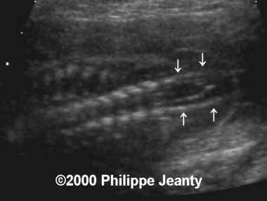 spina_bifida_sb4