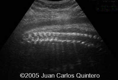 SPINE