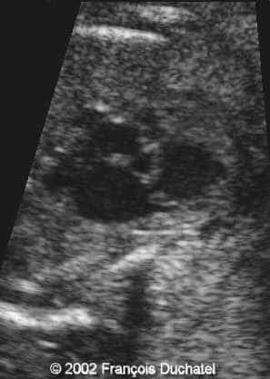 stenose pulm3